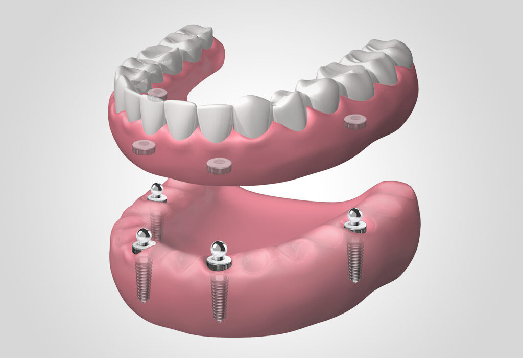 implantes dentales en Burgos