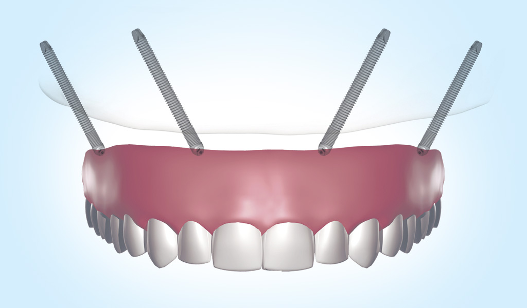 Implantes dentales en Burgos