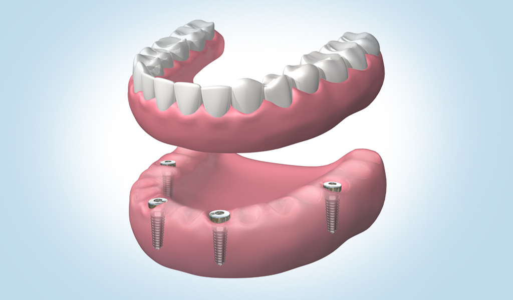 Implantes dentales en Burgos