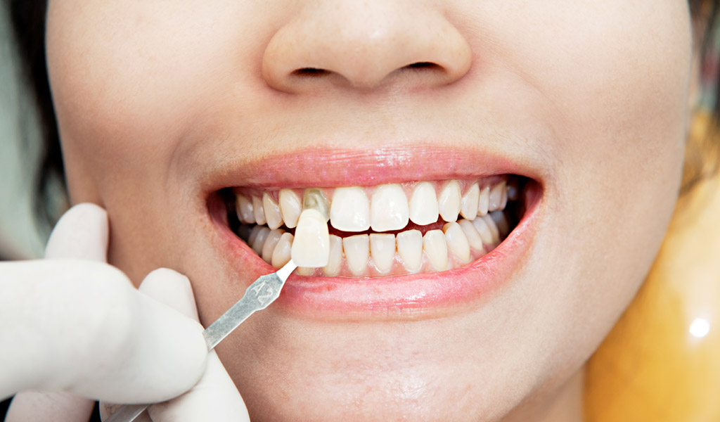 Estética dental en Burgos