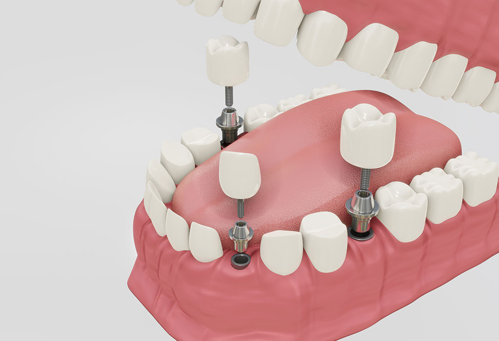 Prótesis fija sobre implantes dentales en Burgos